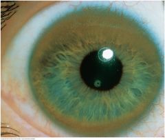 A golden to red brown ring, sometimes shading to green or blue, from copper deposition in the periphery of the cornea found in Wilson's disease. Due to a rare autosomal recessive mutation of the ATO7B gene on chromosome 13 causing abnormal copper ...