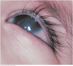 A superficial grayish white opacity in the cornea, secondary to an old injury or to inflammation. Size and shape are variable. Do not confuse with the opaque lens of a cataract, visible on a deeper plane and only through the pupil.


 