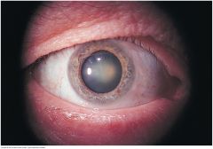 Opacities of the lenses visible through the pupil. Risk factors are older age, smoking, diabetes, corticosteroid use.


 


Nuclear cataract - looks gray when seen by a flashlight. If the pupil is widely dilated, the gray opacity is surrounde...