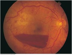 Develops when blood escapes into the potential space between the retina and vitreous. This hemorrhage is typically larger than retinal hemorrhages. Because it is anterior to the retina, it obscures any underlying retinal vessels. In an erect patie...