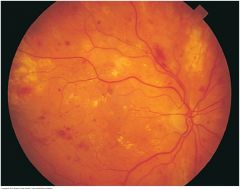 Small, rounded, slightly irregular red spots that are sometimes called dot or blot hemorrhages. They occur in a deeper layer of the retina than flame-shaped hemorrhages. Diabetes is a common cause


 