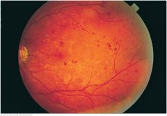 Tiny, round, red spots commonly seen in and around the macular area. They are minute dilatations of very small retinal vessels; the vascular connections are too small to be seen with an ophthalmoscope. A hallmark of diabetic retinopathy


 