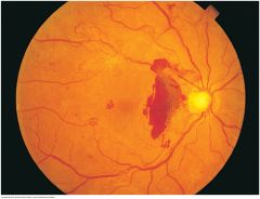 Refers to the formation of new blood vessels. They are more numerous, more torturous, and narrower than other blood vessels in the area and form disorderly looking red arcades. A common feature of the proliferative stage of diabetic retinopathy. T...