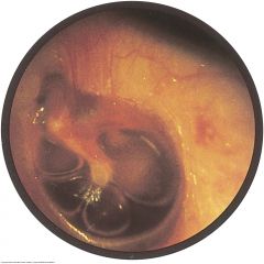 Usually caused by viral upper respiratory infections (otitis media with serous effusion) or by sudden changes in atmospheric pressure as from flying or diving (otitis barotrauma). The eustachian tube cannot equalize the air pressure in the middle ...