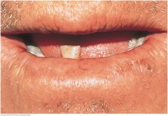 Results from excessive exposure to sunlight and affects primarily the lower lip. Fair-skinned men who work outdoors are most often affected. The lip loses its normal redness and may become scaly, somewhat thickened, and slightly everted. Because s...