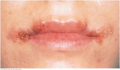 Produces recurrent and painful vesicular eruptions of the lips and surrounding skin. A small cluster of vesicles first develops. As there break, yellow-brown crusts form. Healing takes 10 to 14 days. Both new and erupted vesicles are visible here
...