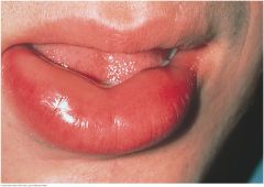 A localized subcutaneous or submucosal swelling caused by leakage of intravascular fluid into interstitial tissue. Two types are common. When vascular permeability is triggered by mast cells in allergic and NSAID reactions, look for assicated urti...