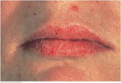 Multiple small red spots on the lips strongly suggest this. An autosomal dominant endothelial disorder causing vascular fragility and arteriovascular malformations (AVMs). Telangiectasias are also visible on the oral mucosa and fingertips. Noseble...