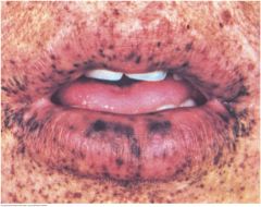 Look for prominent small brown pigmented spots in the dermal layer of the lips, buccal mucosa, and perioral area. These spots may appear on the hands and feet. In the autosomal dominant syndrome, these characteristic skin changes accompany numerou...