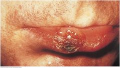 The ulcerated papule with an indurated edge usually appears after 3 to 6 weeks of incubating infection from spirochete Treponema pallidum. These lesions may resemble a carcinoma or crusted cold sore. Similar primary lesions are common in the phary...
