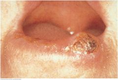 Like actinic cheilitis, squamous cell carcinoma usually affects the lower lip. It may appear as a scaly plaque, as an ulcer with or without a crust, or as a nodular lesion, illustrated here. Fair skin prolonged exposure to the sun are common risk ...