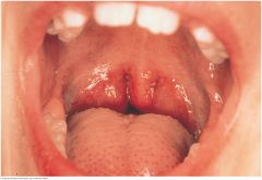 Normal tonsils may be large without being infected, especially in children. They may protrude medially beyond the pillars and even to the midline. Here they touch the sides of the uvula and obscure the pharynx. Their color is pink. The white marks...
