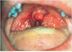 This red throat has a white exudate on the tonsils. This, together with fever and enlarged cervical nodes, increases the probability of group A streptococcal infection or infectious mononucleosis. Anterior cervical lymph nodes are usually enlarged...