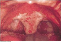 Diphtheria, an acute infection caused by Corynebacterium diphtheriae, is now rare but still important. Prompt diagnosis may lead to life-saving treatment. The throat is dull red, and a gray exudate (pseudomembrane) is present on the uvula, pharynx...