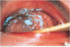 Thrush is a yeast infection from Candida species. Shown here on the palate, it may appear elsewhere in the mouth (see p. 289). Thick, white plaques are somewhat adherent to the underlying mucosa. Predisposing factors include  (1) prolonged treatm...