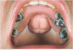 A torus palatinus is a midline bony growth in the hard palate that is fairly common in adults. Its size and lobulation vary. Although alarming at rst glance, it is harmless. In this example, an upper denture has been tted around the torus.