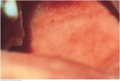Koplik’s spots are an early sign of measles (rubeola). Search for small white specks that resemble grains of salt on a red background. They usually appear on the buccal mucosa near the rst and second molars. In this photo, look also in the up...