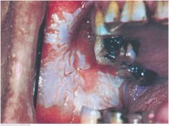 A thickened white patch (leukoplakia) may occur anywhere in the oral mucosa. The extensive example shown on this buccal mucosa resulted from frequent chewing of tobacco, a local irritant. This benign reactive process of the squamous epithelium may...