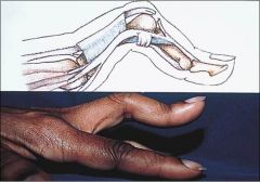 Name and describe this deformity - what disease is it seen in?