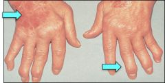 Symmetric polyarthritis - disease? Clues?


 