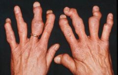 Seen in 5% of Psoriatic arthritis - what is this called?