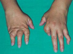 What is this characteristic of arthritis mutilans called, how does it happen and when is it seen?