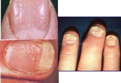 Three nail deformities seen in PsA?