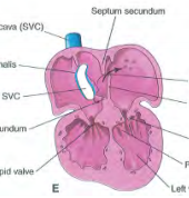 Ventricular septum grows from the apex of the heart superiorly=> forms a thick but incomplete septum
=> final part of septum closed by thin membrane