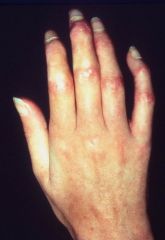 Puffy fingers of scleroderma - which phase is this?
