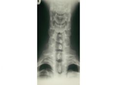 Cervical Rib (Transitional vertebra)