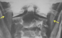 Stylohyoid Ligament Calcification