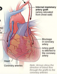 Coronary arteries which supply the heart can be blocked and a vessel we can choose to bypass the artery is the internal thoracic artery

Remove a portion of internal thoracic artery to bypass coronary artery