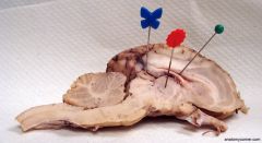 Frontal lobe of cerebellum
Optic chiasma
parietal lobe
cerebellum
pineal gland
arbor vitae
corpora quadrigemina
fourth ventricle
medulla oblongata
pons
