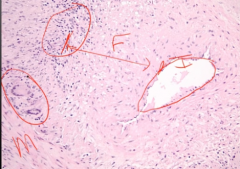 -broad area of fibrosis in between intima and media (separation should not be there)
-fibrosis >> narrow lumen
-inflammation in blood vessel wall
-giant cells also observed