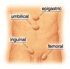 










•Umbilical hernia
 •Epigastric hernia 
 •Incisional hernia 
 •Diastasis recti 
