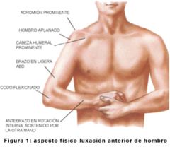 Signo de la charretera

Miembro superior en supinación

Incapacidad de tocar hombro contrario

abducción del brazo