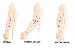 Entre las proyecciones de la línea del brazo y la del antebrazo

Normal: 5-15°

> 15° cubitus vaLgus (hacia afuera)

< 5° cubitus varus (hacia adentro)