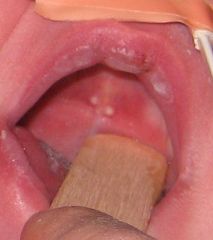 small, benign whitish-yellow masses on either side of the raphe on the hard palate of a newborn