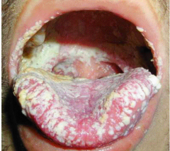 Describe. 
a. Anal condylomata b. Herpes simplex virus c. Psoriasis d. Oral warts e. Oral candidiasis f. Oral ulcers g. Pneumocystic jirovecii h. Cytomegalovirus Retinitis i. Kaposi sarcoma j. Human papillomavirus k. Dermatomal herpes zoster l....