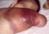 large, congenital vascular tumors (not true hemangiomas but can cause a severe CONSUMPTIVE COAGULOPATHY and death)


