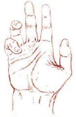 Mano del predicador

2do dedo en extensión
Felxión progresiva 2-5
Atrofia tenar
Abducción del pulgar