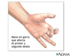 Mano en garra

Abducción del 5to dedo
Atrofia hipotenar
leve hipotrofia tenar