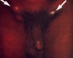serotypes with L in them

STD in homosex males populus in SA,Africa,asia

aquired by abrasions, transient papules on external genitalia

massive lymphandopathy in groin and elephantitis, LN blocked and skin over LN can get thin

f,c,HA
monocytes
I...