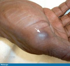 tender, pea sized intradermal nodules on pads of fingers and toes