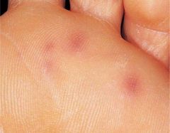 painless, small erythematous or hemorrhagic lesions on palms and soles
