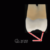 Anterior teeth, most bicuspids and second molars develop from four lobes while first molars develop from five lobesmound on the crown portion of a tooth that makes up a major division of its occlusal surface .Found on cuspids, bicuspids and molars