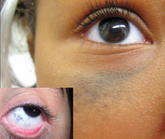 unilateral, irregularly speckled areas of blush, should receive yearly ophtho checkups to look for melanoma