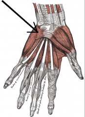 O:  Flexor retinaculum and palmar aponeurosis
I:  Base of 5th proximal phalanx
A:  Steadies skin of palm to help with grip
Nerve:  Ulnar