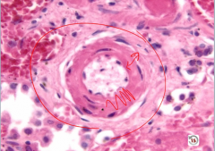 Hyaline Arteriolosclerosis
 
wall thickened by hyaline