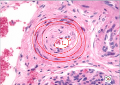 Hyperplastic Arteriolosclerosis
 
-onion skinning = too many layers of smooth muscle cells
-narrow lumen >> reduced vessel caliber
